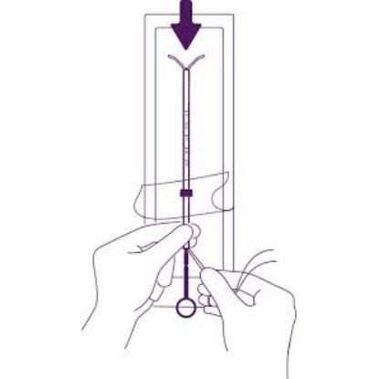 [MPMWLEV04A] LEVOSERT (LEVONORGESTREL 20MCG / 24 HOURS) IUD X 1 (POM)